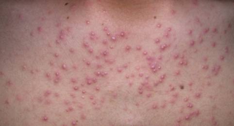 สิวสเตียรอย